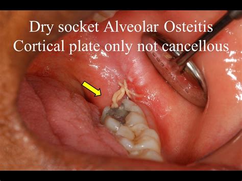 Clinical Dentistry Courses | Training & Lectures | Dry Socket Treatment