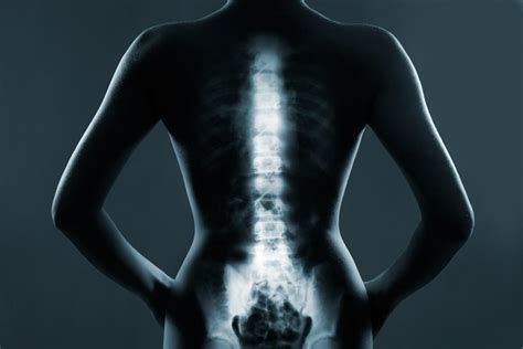 Synovial Cysts — A Lesser Known Cause Of Back Pain Neurosurgery Located In Birmingham Al