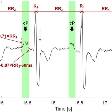 Example of P waves detection during AFIB (signal no. 48 from BUT PDB ...