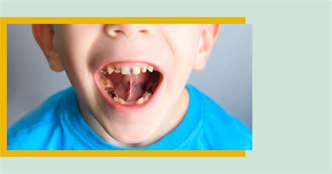 Cómo se tratan las caries dentales en niños Clínica dental Albiol