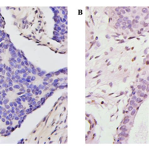 Tissue Pd L Expression By Ihc A Primary Breast Cancer Tumor Cells