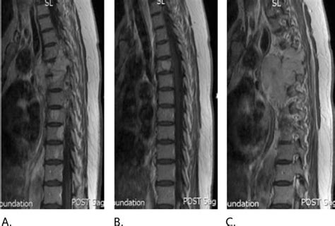 One Stage Resection Of Giant Invasive Thoracic Schwannoma Case Report