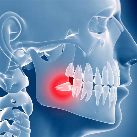 QUANDO BISOGNA TOGLIERE I DENTI DEL GIUDIZIO Centro Beauty Dental