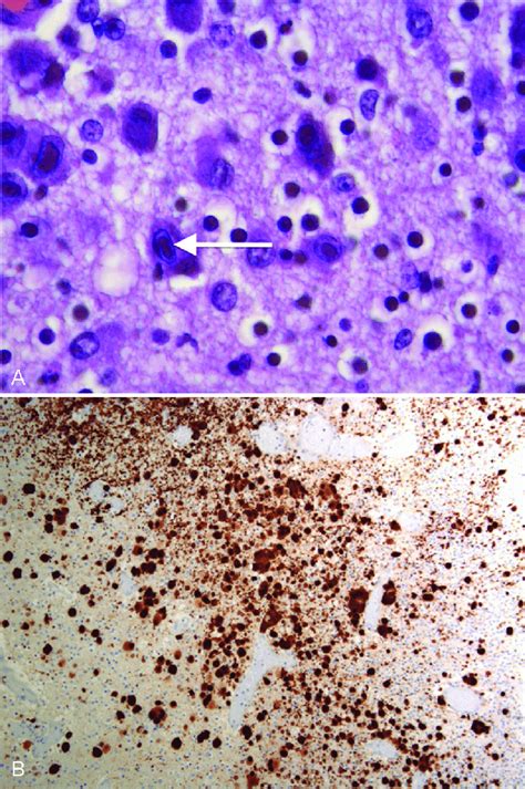 Germinal Matrix Histology