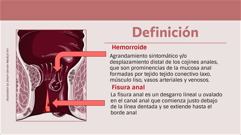 Solution Cx Hemorroides Y Fisura Anal Studypool