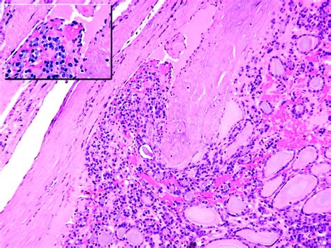 follicular carcinoma pathology