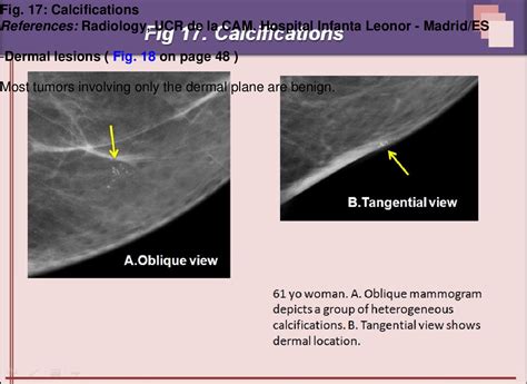 Superficial Breast Lesions A Comprehensive Review Of Skin And