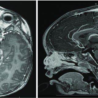 Axial T Sequence With Gadolinium Axial Left And Sagittal Right