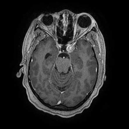 Planum Sphenoidale Meningioma Image Radiopaedia Org