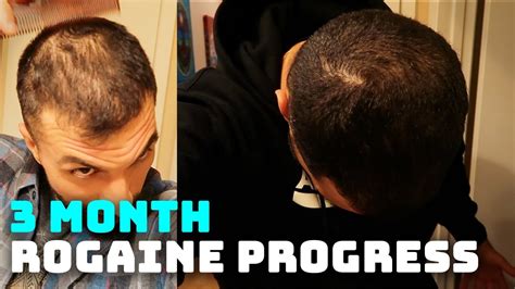 3 Month Rogaine Results And Progress Minoxidil Youtube