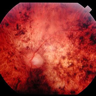 Fundus Of A Year Old Patient With Cone Rod Dystrophy Due To