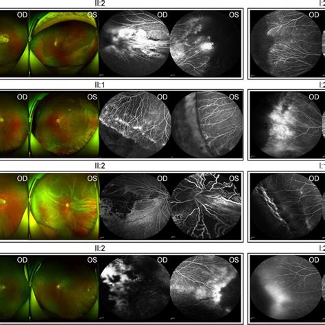 Fundus Photography And Fluorescein Angiography Of Individuals Affected