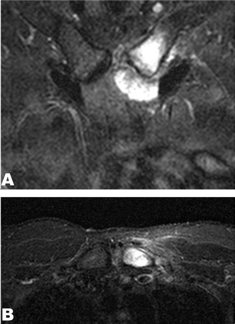 Full Text Magnetic Resonance Imaging Of Sternoclavicular Joint