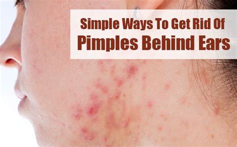 Pimples Behind The Ears 6 Home Remedies And Causes How To Get Rid Of Pimples Pimples Under