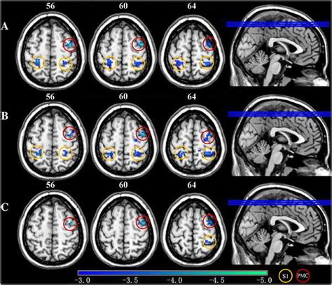 Significant Differences In ReHo DC And ALFF Between Migraineurs