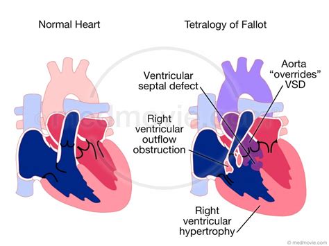 Tetralogy Of Fallot Diagram