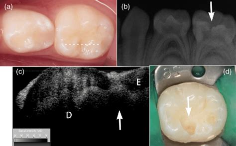 Images Obtained From Lower Second Primary Molar 5 Years Male A