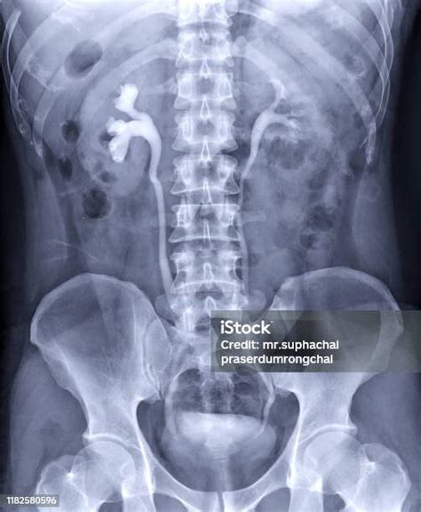 Intravenous Pyelogram Or Ivp Is An Xray Exam Of Urinary Tract After