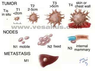 Breast Cancer Stages | MedicineBTG.com