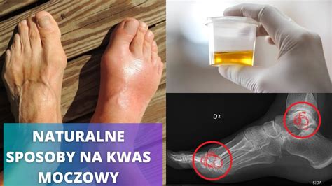 Obni Kwas Moczowy Naturalnymi Produktami Najlepsze Domowe Sposoby