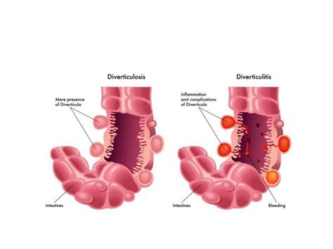 Solution Diverticulosis And Malabsorption Studypool