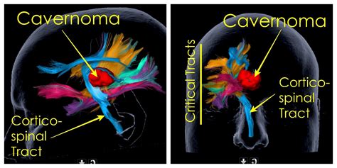 Cavernoma Surgery