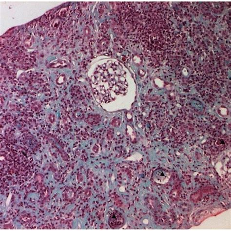 Microscopic Examination Of Renal Biopsy Showing Prominent Interstitial