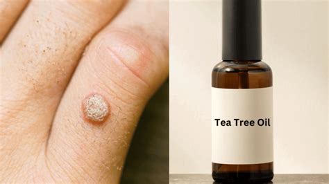 Tea Tree Oil For Warts Use Benefits Side Effects