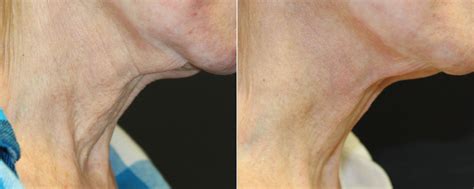 Skin Rejuvenation photos | Beverly Hills, CA. | Patient 16254