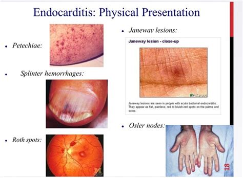 Roth Spots Endocarditis