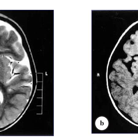 MRI of 15-month-old female infant with chronic kernicterus. a) Axial ...