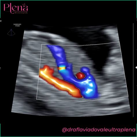 Ducto Venoso Onda A Positiva - Ducto Venoso Com Onda A Positiva - BRAINCP
