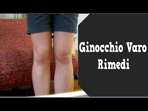 Ginocchio Varo Rimedi Come Correggere Le Gambe A X Ginocchio Valgo