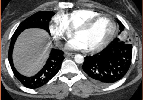 Hampton's hump : r/Radiology