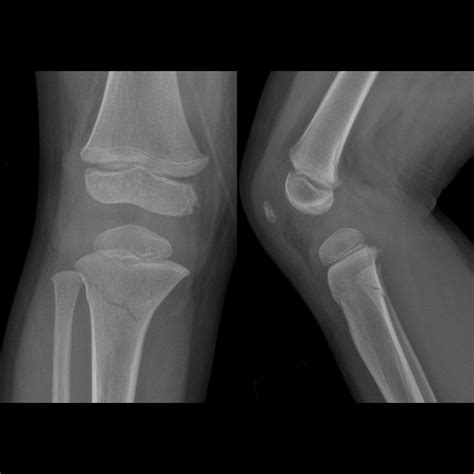 FractureTrampoline02MDKneePainAfterBouncingOnTrampolinePlain2yo