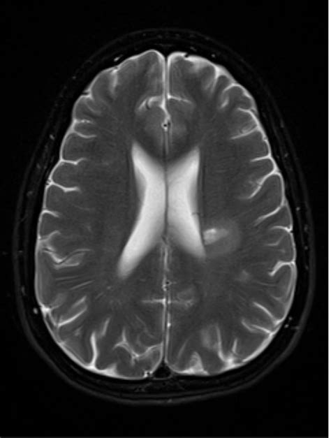 My most symptomatic MS lesions. : r/Radiology