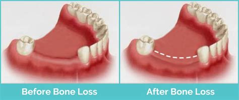 Bone Loss In Teeth Causes Signs And Treatment Longevita