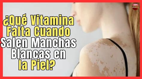 Descubre Cómo Combatir Las Manchas Blancas En La Piel Causadas Por