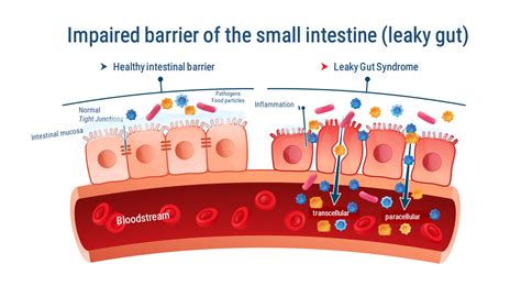 The Leaky Gut Syndrom Simply Explained Causes And Solutions