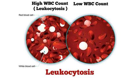 Leukocytosis: Symptoms, Causes and Treatments – New Life Ticket