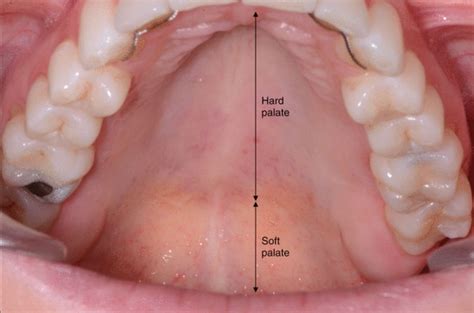 What Is The Hard Palate