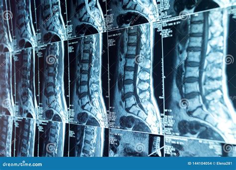 MRI Scans of the Lumbosacral Spine Stock Photo - Image of human, male ...