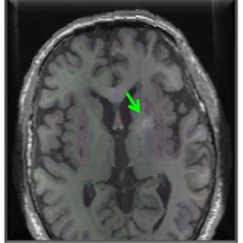 T1 Axial Mri With Subcortical Labeling Note The Hyperintense Signal Of