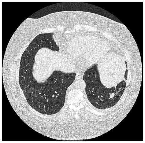 Plasma Cell Granuloma, Pulmonary; Granuloma, Plasma Cell, Pulmonary ...