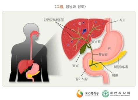 담석증 환자 급증 원인은 무리한 다이어트 올바른 방법은… 어려우면 이것 드세요 세계일보