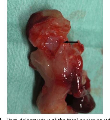 Figure 1 from Prenatal diagnosis of pentalogy of cantrell with ...