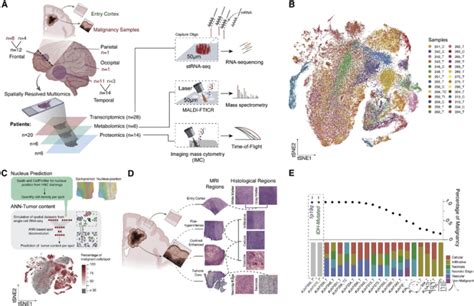 Sci案例分享胶质母细胞瘤空间多组学解析肿瘤微环境 知乎