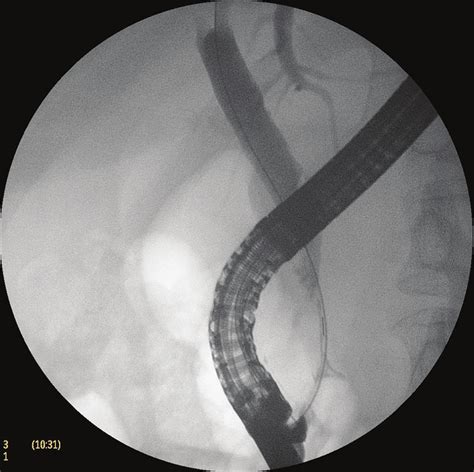 Distal Common Bile Duct Dilatation Stricture Seen On Cholangiogram