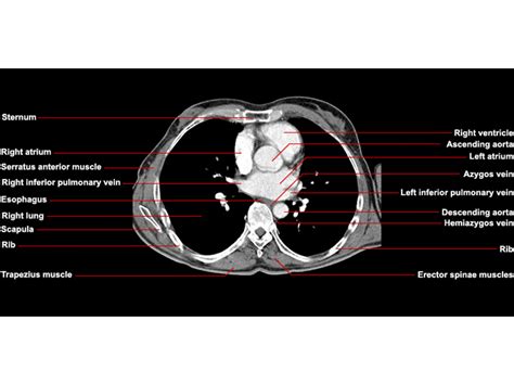 Chest Wall Muscles Ct Anatomy