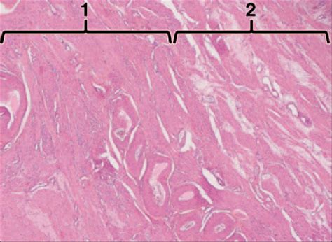 Photomicrograph H And E ×25 Of Uterine Section Of 37 Year Old Woman